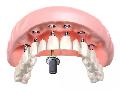Имплантация на 6 имплантах цена в стоматологии Свой Дантист в Мытищах